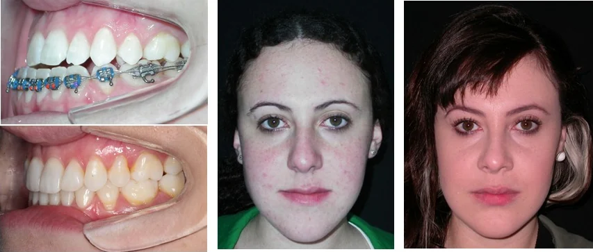 Antes e depois de tratamento ortodôntico concluído em 10 meses