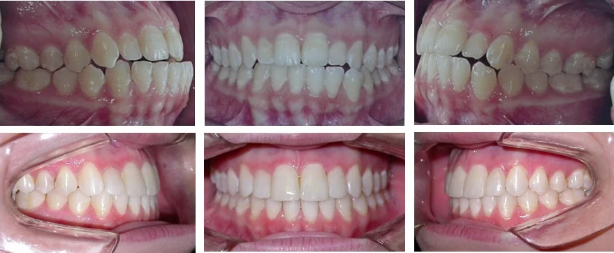 Antes e depois de tratamento ortodôntico concluído em 11 meses