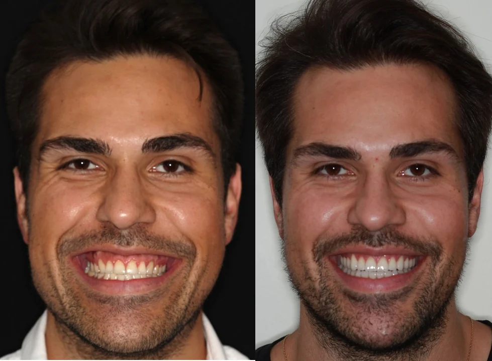 Antes e depois de tratamento ortodôntico concluído em 9 meses