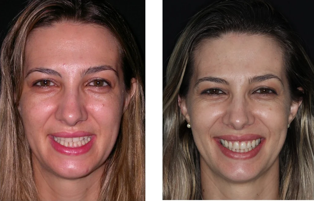 Estética do sorriso — documentação de caso 8